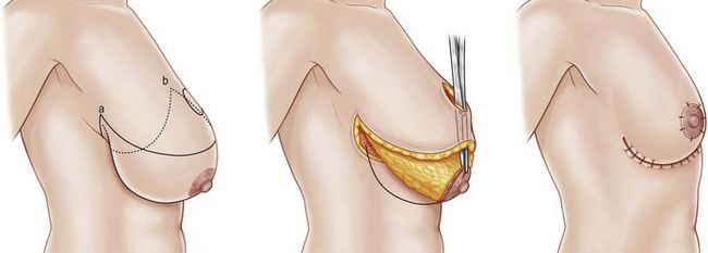 этапы операции по уменьшению груди